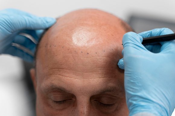 Expert Hair Transplant in Esenler, Istanbul