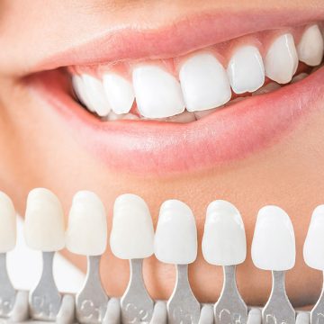 Dentalveneers