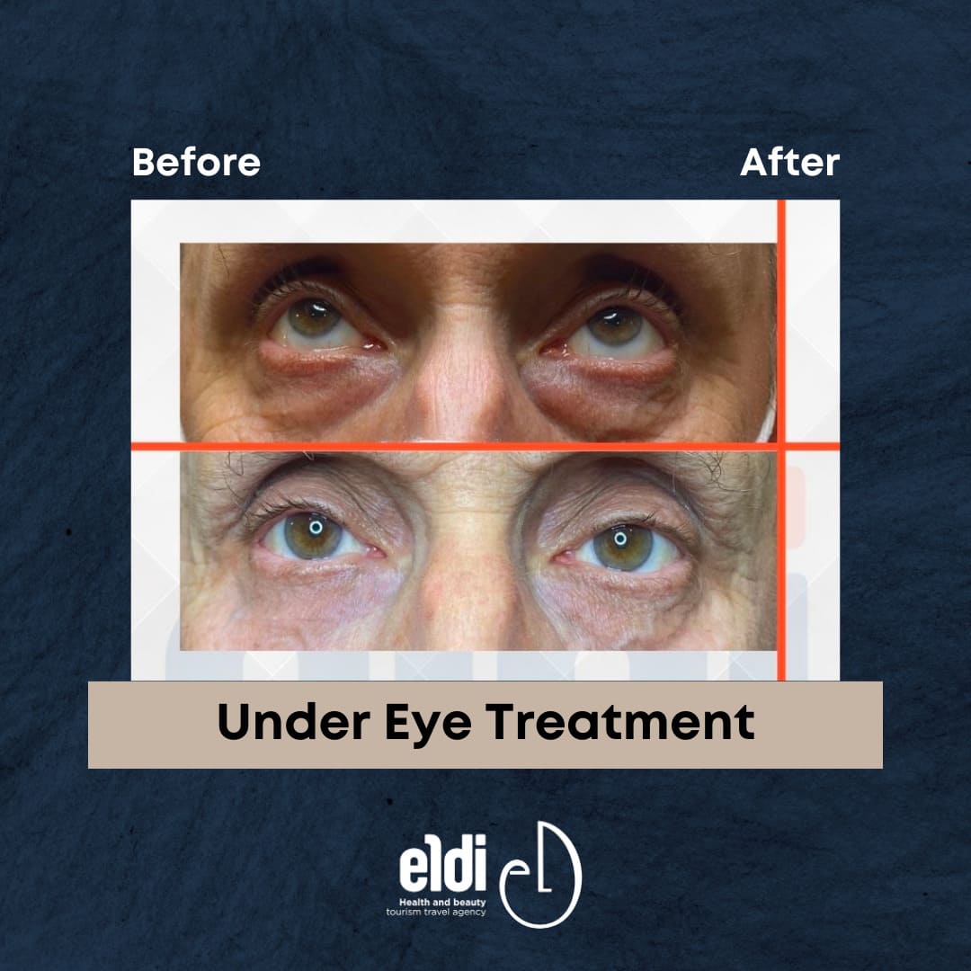 Under Eye Treatment