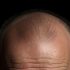The Comprehensive Guide to Your First Hair Transplant in İzmir