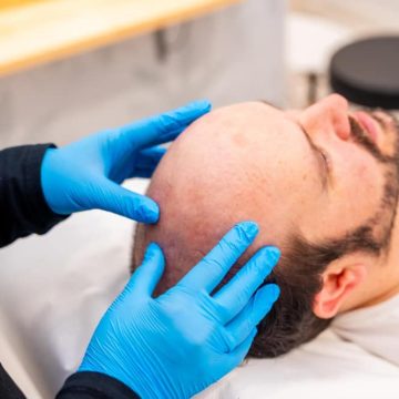 Preparing for Your Hair Transplant Trip to Turkey: Tips and Advice